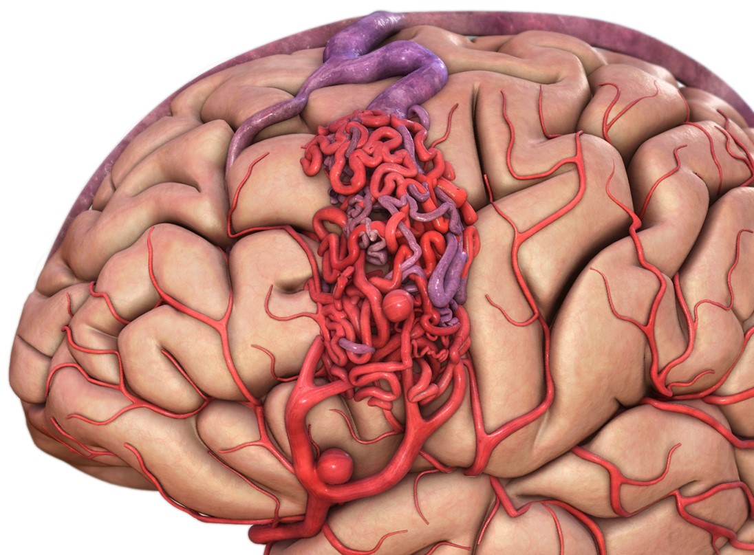 Serebral AVM(Damar yumağı) Tedavisi