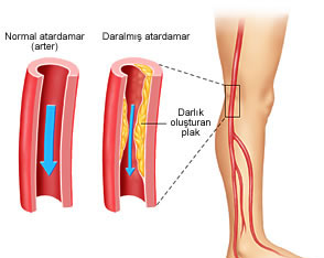 Atardamar, toplardamar tedavileri