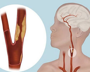 Karotis(Şahdamar) darlık tedavisi